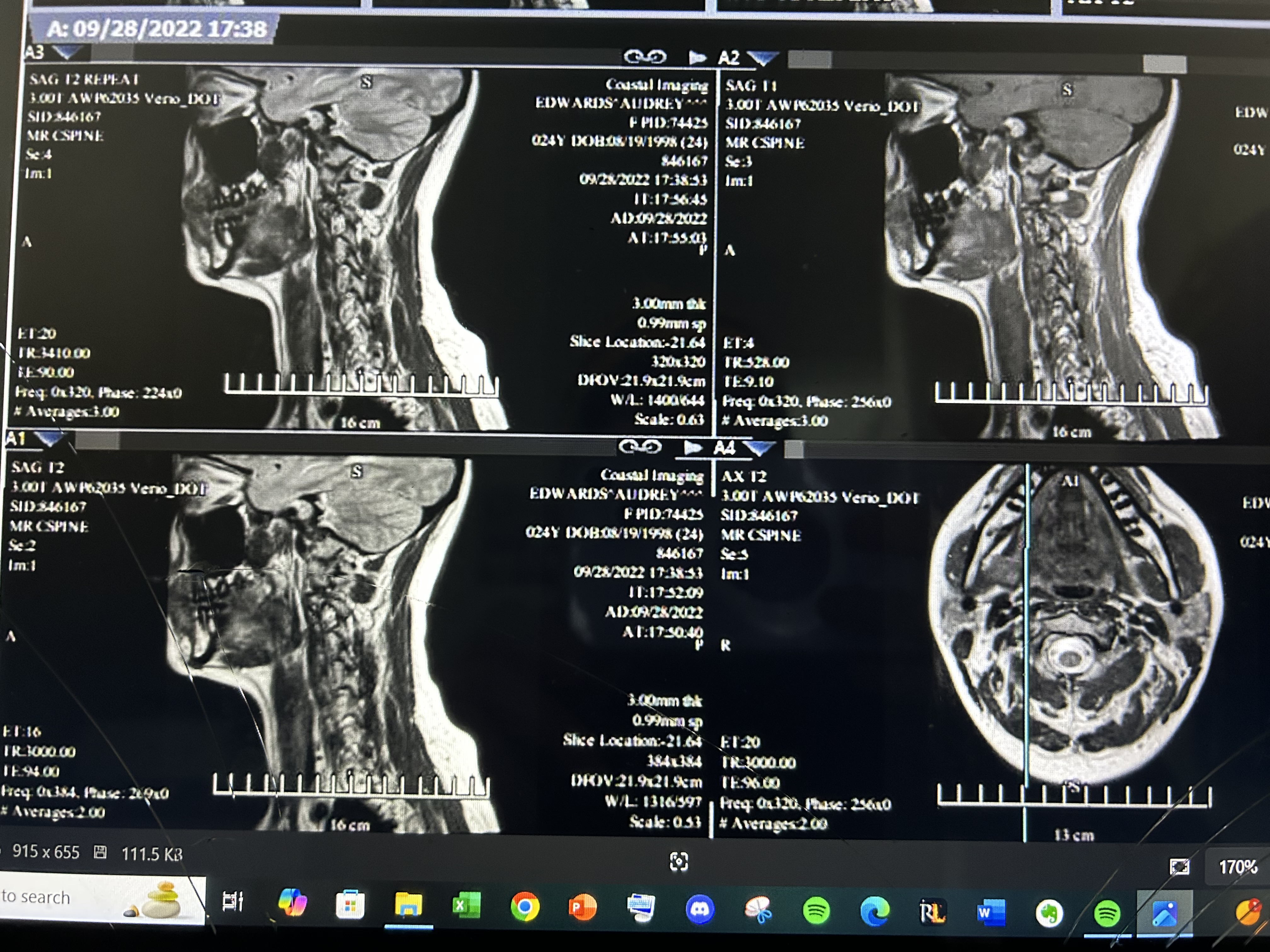 MRI confirming C5-C6 cervical disc protrusion