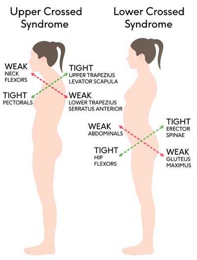 Upper and lower crossed syndrome patterns